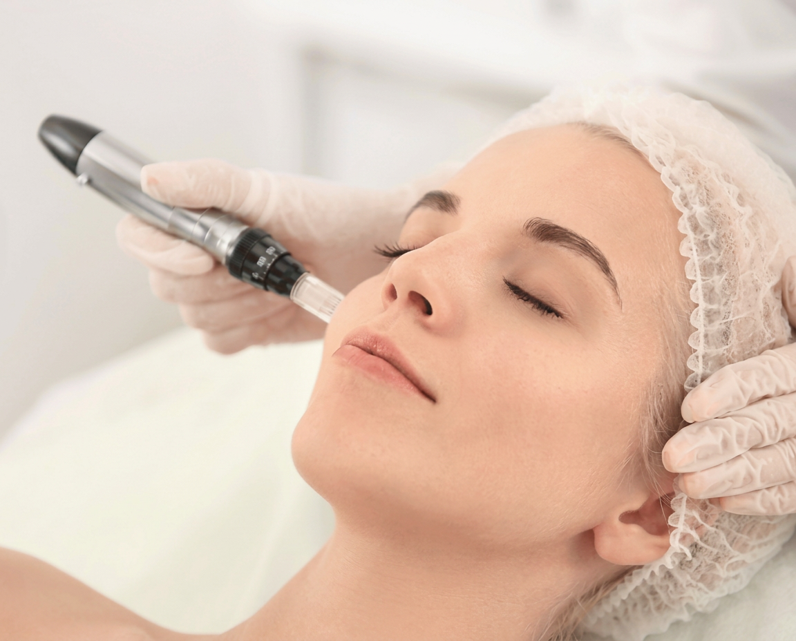 Microneedling bei Beauty Concept in Weinheim