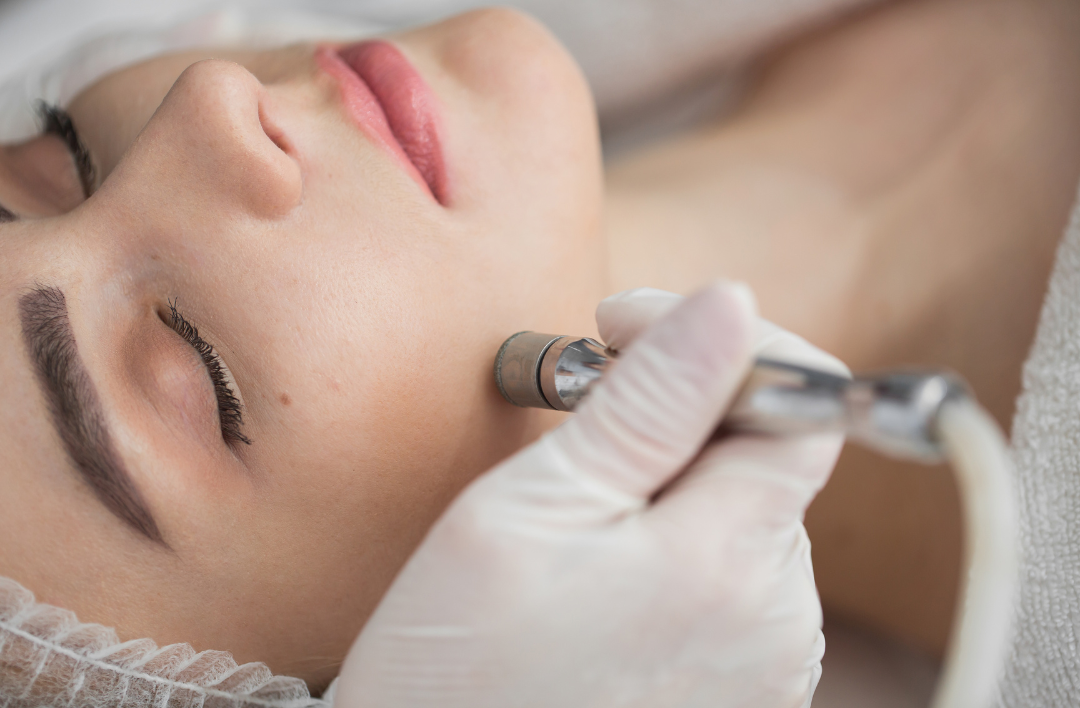 Microdermabrasion bei Beauty Concept in Weinheim